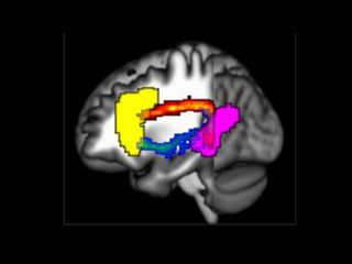 Using magnetic resonance imaging of the brain, researchers can visualize the two main language processing regions, Broca's region (yellow) and Wernicke's region (purple), as well as the (blue and orange) pathways between them. Credit: Stephen Wilson