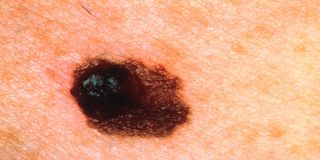 melanoma-100608-02