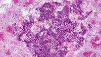 A close up of the pancreas, where purple and pink stained cells can be seen with dark dots for their nucleii