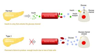 For a person with type 1 diabetes, the pancreas's beta cells get killed off and so the body can’t produce insulin. Insulin is the key that locks into a certain receptor on the surfaces of your cells and allows glucose (sugar) to leave the bloodstream and enter your cells. Without insulin the sugars just build up in the blood and can’t get into your cells.