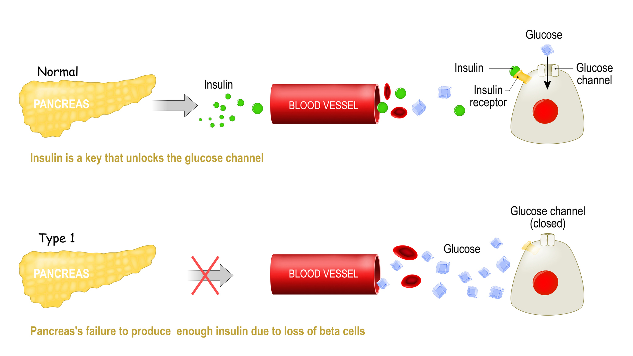 For a person with type 1 diabetes, the pancreas's beta cells get killed off and so the body can't produce insulin. Insulin is the key that locks into a certain receptor on the surfaces of your cells and allows glucose (sugar) to leave the bloodstream and enter your cells. Without insulin the sugars just build up in the blood and can't get into your cells.