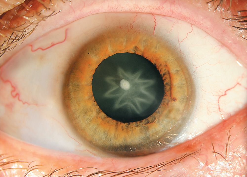 A close-up of a man&#039;s eye reveals a star-shaped cataract.