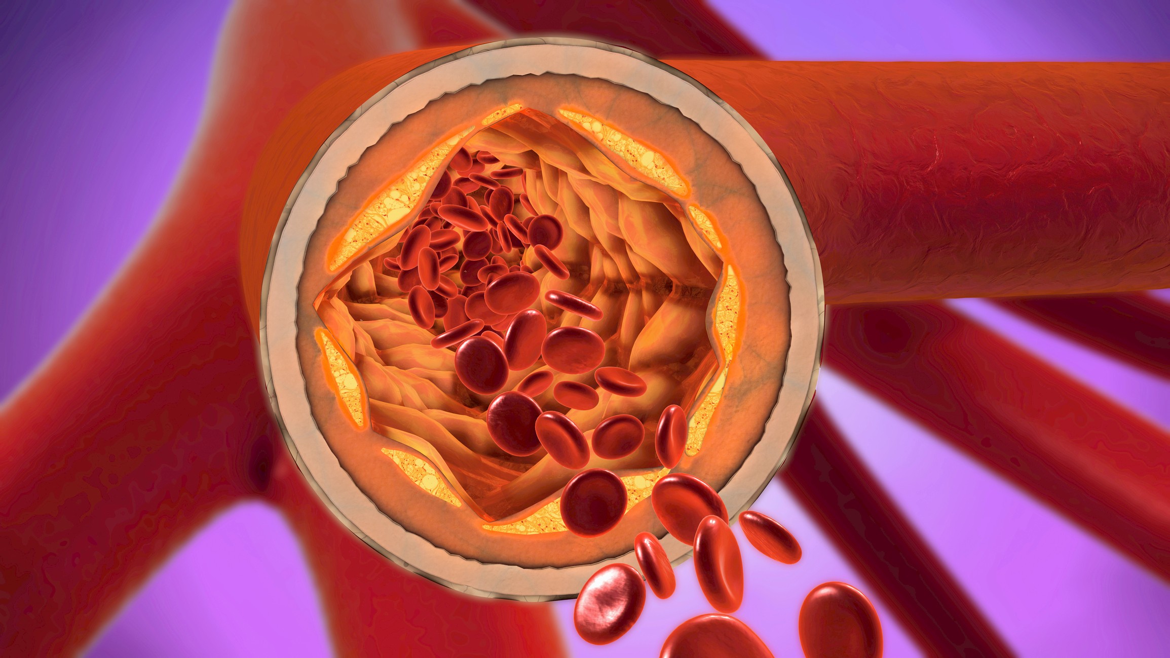 An illustration of atherosclerosis in a blood vessel.
