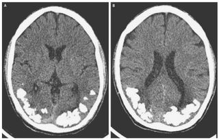 A CT scan of the brain showing calcification.