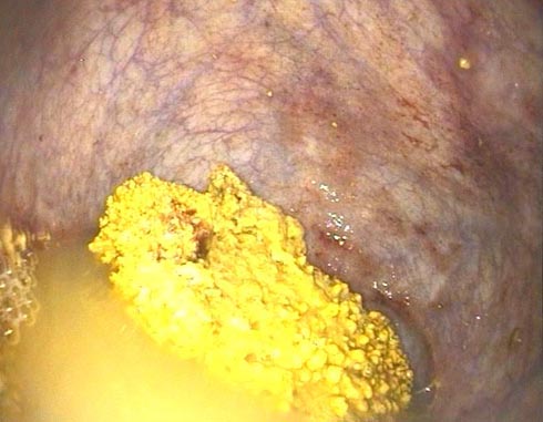 An equine bladder stone