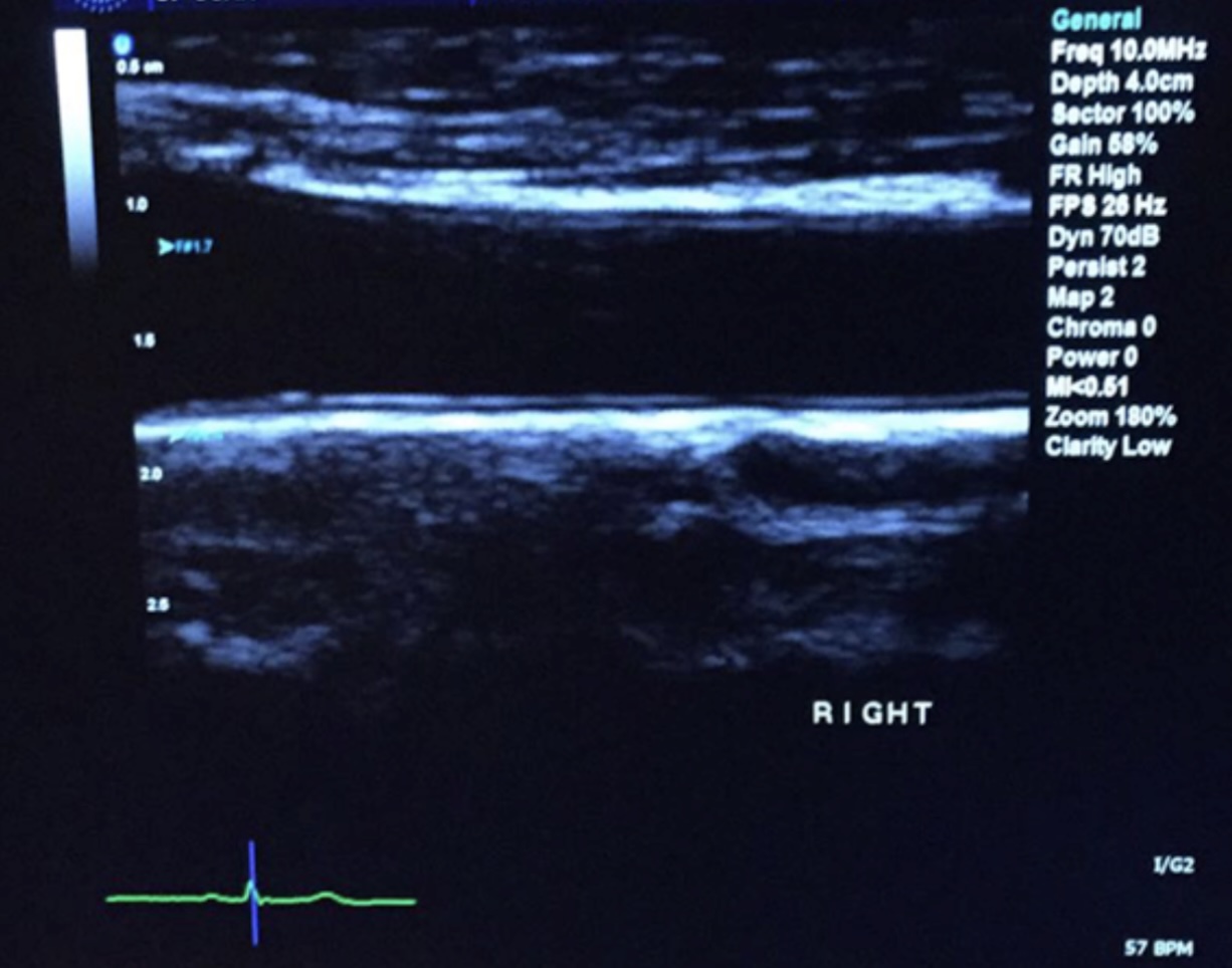 an ultrasound display showing the carotid artery