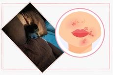 Composite image of a child hiding under a duvet and an illustration of impetigo blisters around a mouth. The images are surrounded by a pink border against a neutral background.