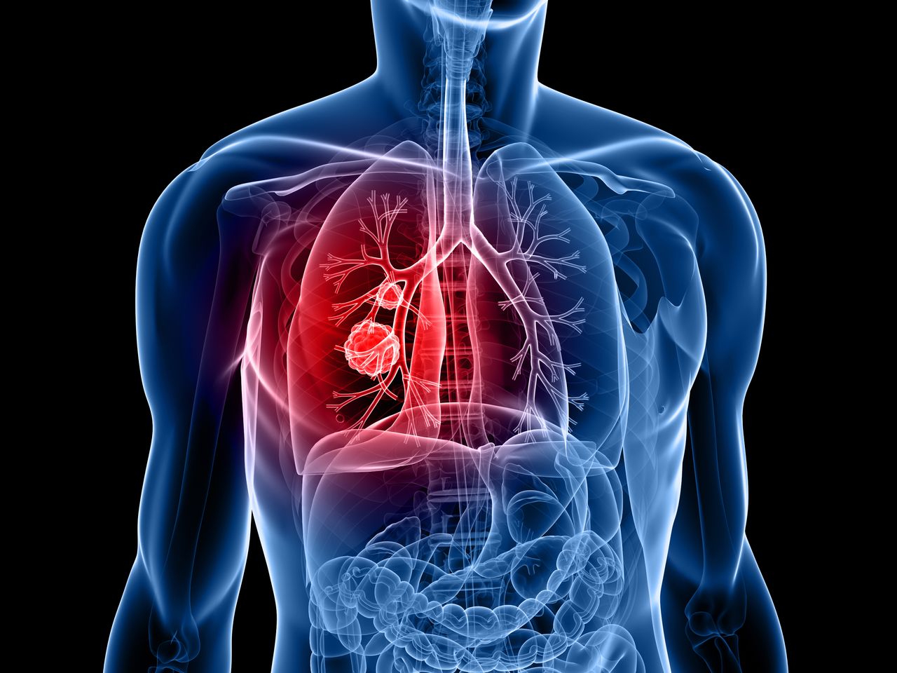 lung cancer.