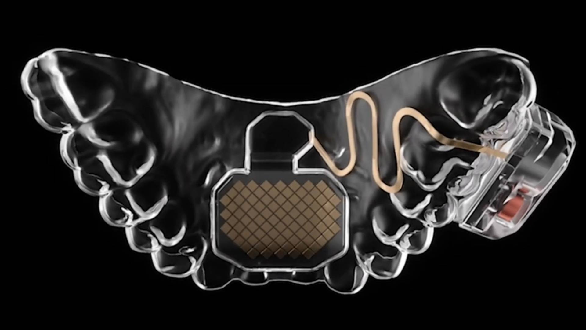 The top half of a retainer, with a flexible copper circuit encased inside the dental resin. A small power pack is attached on the right-hand side.