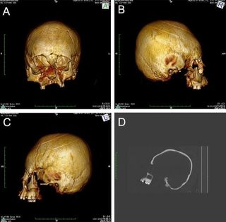 CT scans of the skull that had a "circular-erect"deformation