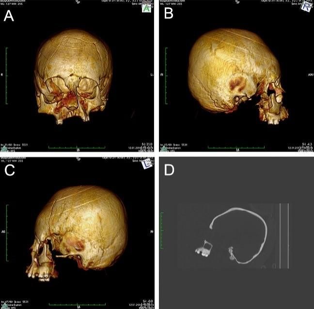 CT scans of the skull that had a &quot;circular-erect&quot;deformation