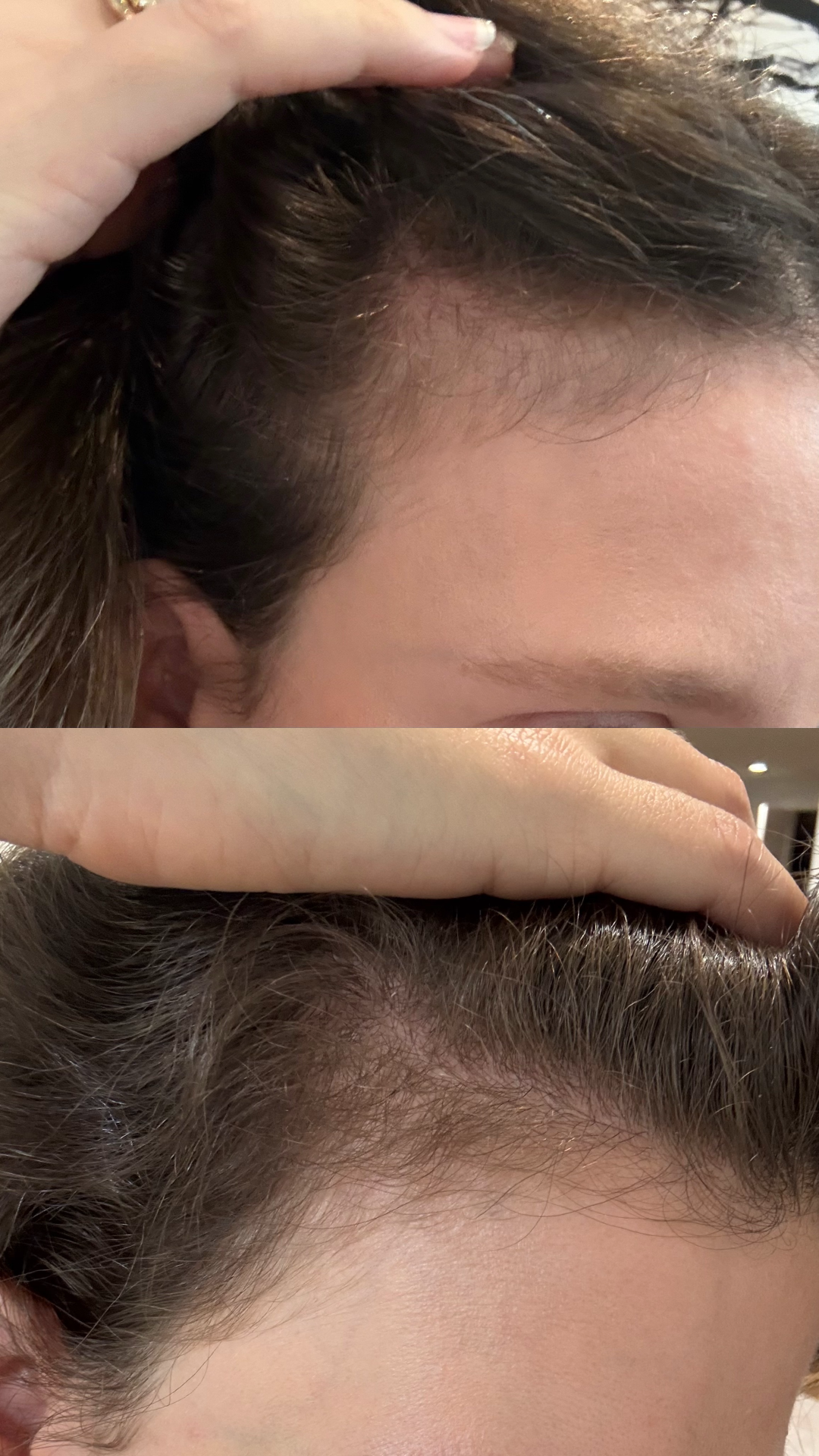 Jamie Chevron's temples before and after taking Nutrafol Women.