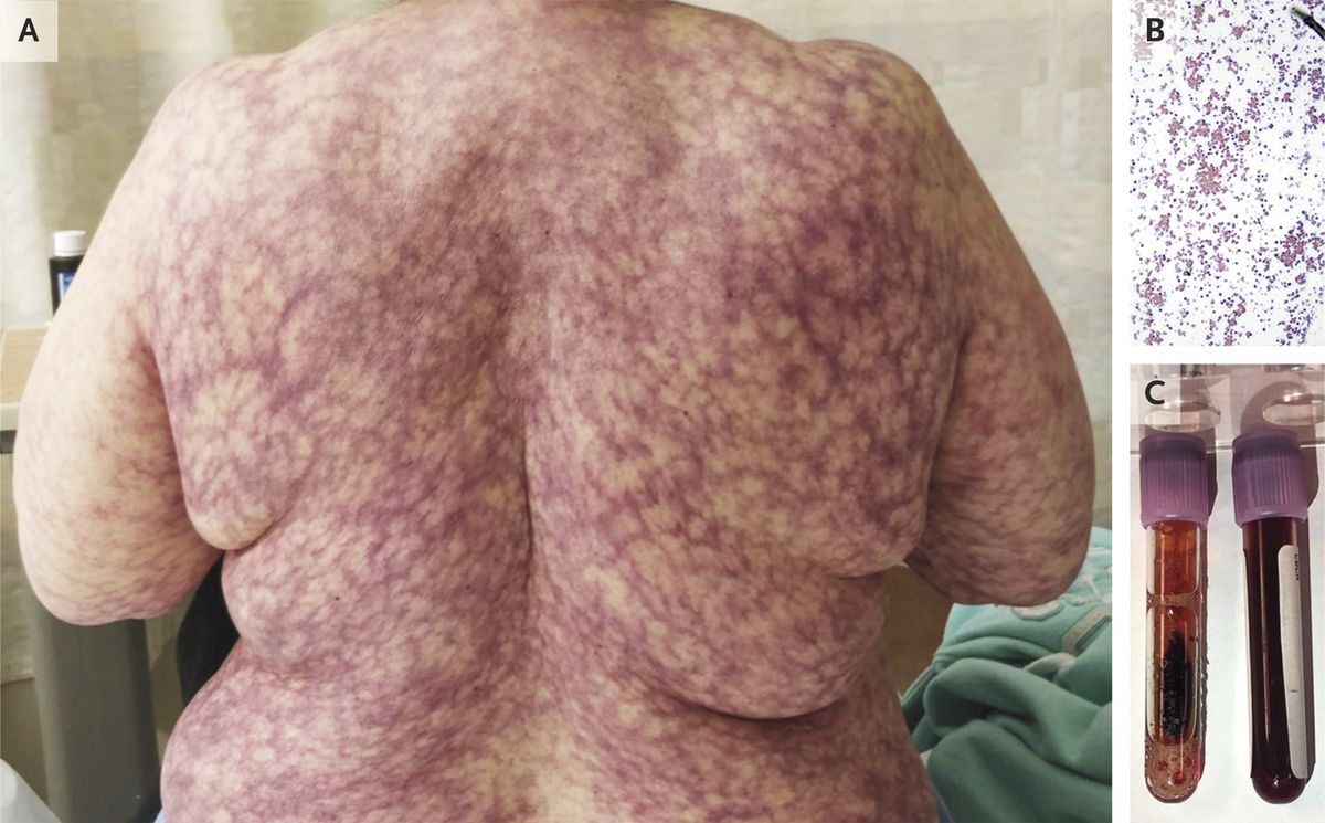 Photo of a rash on a woman&#039;s back, images of blood cells and vials of the patient&#039;s blood 