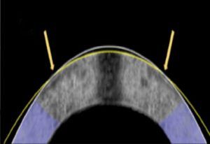 新的无激光眼部治疗的早期试验显示承诺的 a diagram showing how a rabbit cornea has been reshaped