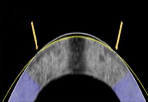 a diagram showing how a rabbit cornea has been reshaped