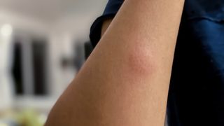 insect bite on a woman's arm