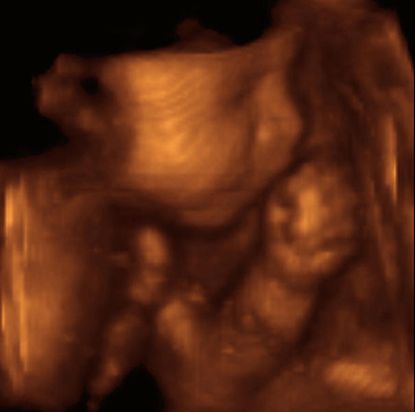 FDA warns against unnecessary ultrasounds