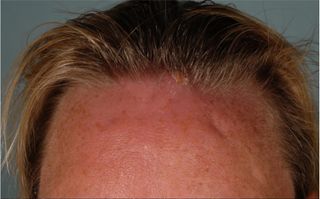 A British woman who visited Uganda unknowingly left the country with fly larvae in her forehead. The fly larva "punctum," or opening, is visible at the woman's hairline. The surrounding area is red and swollen.