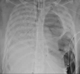 A lung x-ray from the patient before she received the transplant shows damage.
