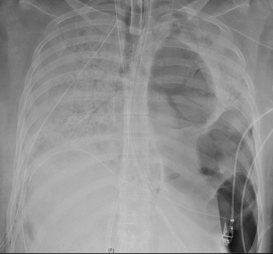 A lung x-ray from the patient before she received the transplant shows damage.