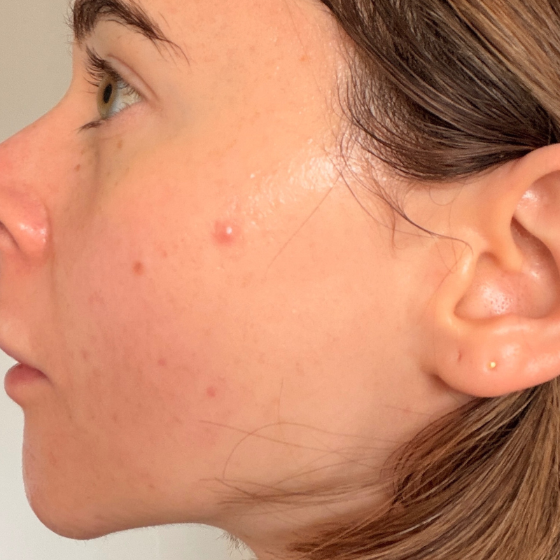 Grace's skin after using the hero mighty patch