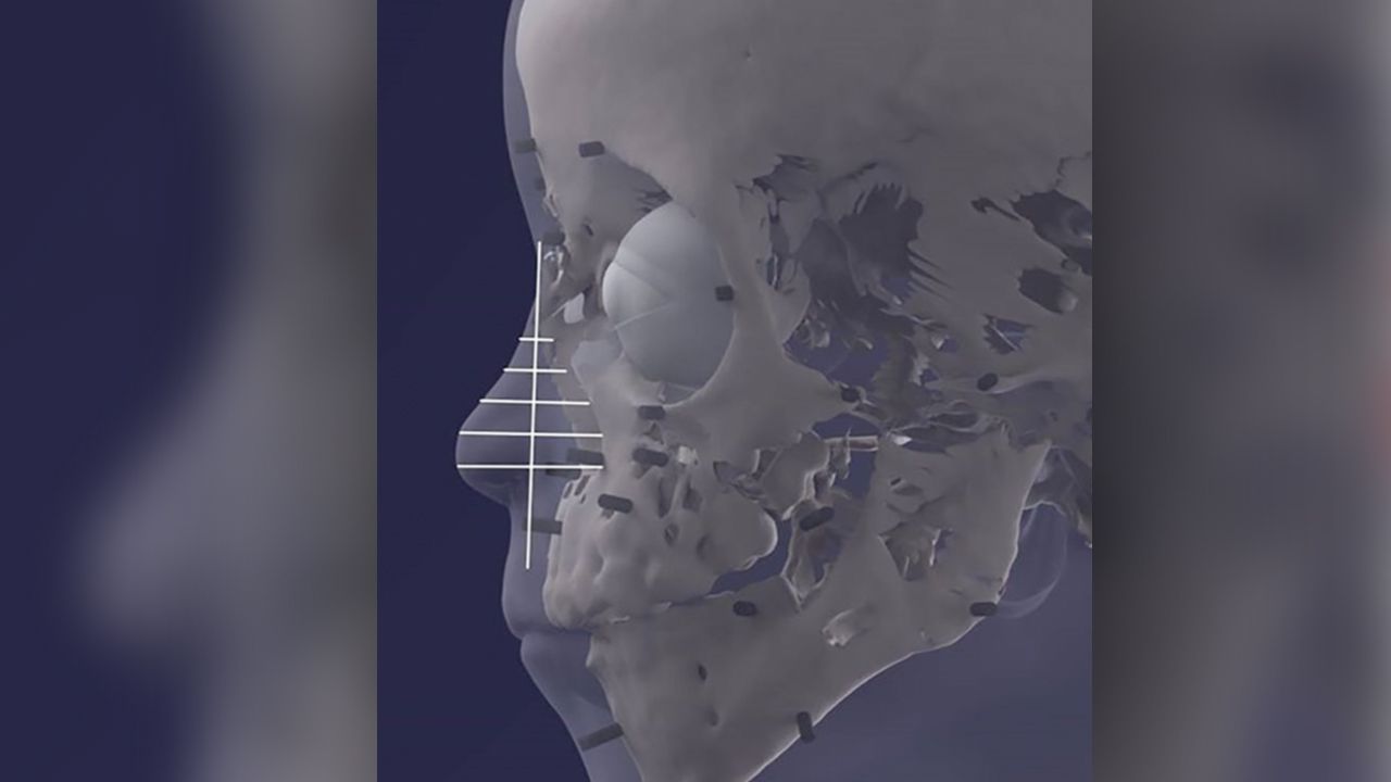 The reconstruction of the boy's nose.