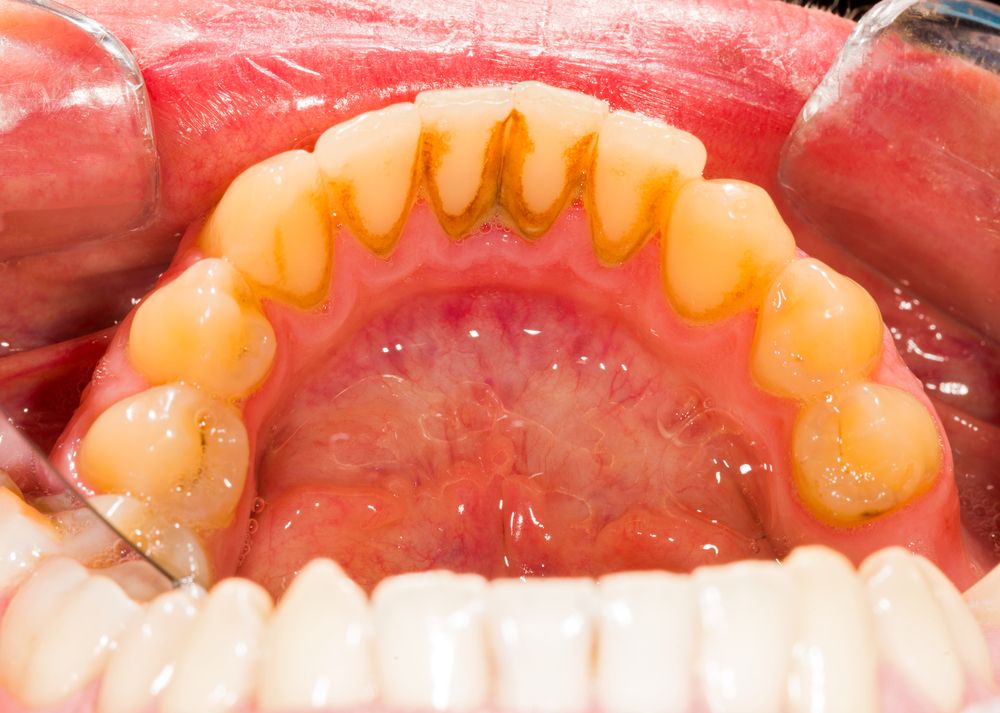 dental plaque