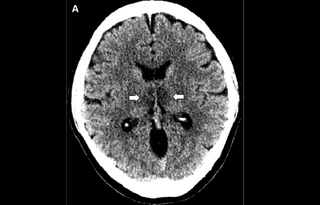 CT scans of the woman's brain revealed symmetrical tissue damage in a region of the brain called the thalamus.