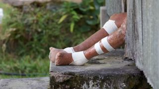 the bandaged and scarred legs of a person with leprosy shown as they're resting on a stone staircase outdoors