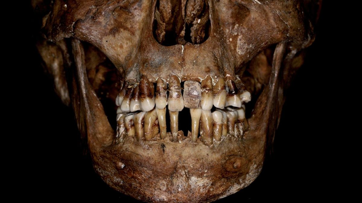 The woman was suffering an inflammation of the gums and bones that had loosened her teeth, so she&#039;d had them fixed in place with fine gold wires.