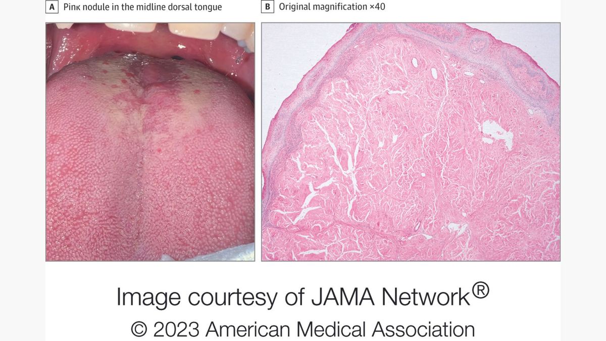 left photo shows a close up photo of a person&#039;s tongue. The right image shows a microscopic scan of tissue sampled from the tongue 