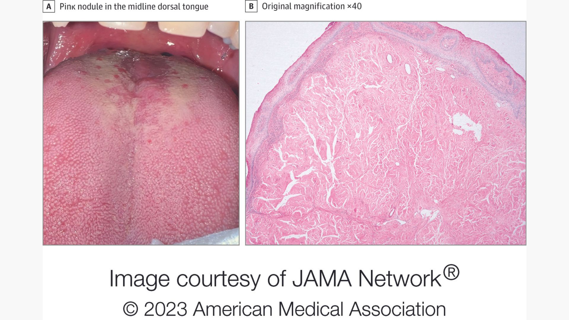 Mysterious bump on a man's tongue had an 'extremely rare' cause | Live ...