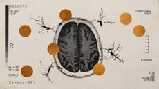 Photo collage of a brain scan, microglia cells, and copper discs