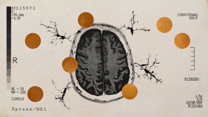 Photo collage of a brain scan, microglia cells, and copper discs