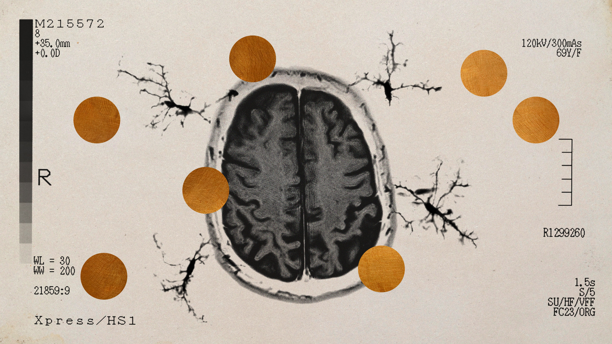Photo collage of a brain scan, microglia cells, and copper discs
