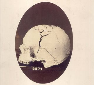 fractured cranium of confederate soldier
