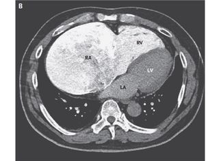 This image shows a cross-sectional view of the man's chest, taken from below, looking up at the heart. The spine is the white mass seen at the bottom of the image. The right side of the heart is shown in white and the left side of the heart is shown in grey. The chambers of the heart are labeled "RA" (right atrium), "RV" (right ventricle), "LV" (left ventricle) and "LA" (left atrium).