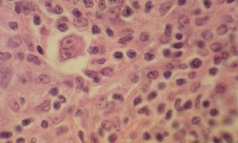 The large, two-nuclei cell i(center) is a characteristic of Hodgkin&amp;#039;s lymphoma: The FDA approved a new drug specifically targeted to this type of cancer for the first time in nearly 35 years.