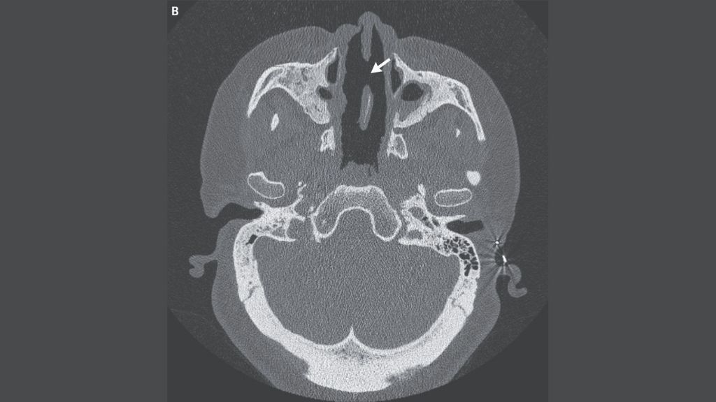 Rare autoimmune disorder caused a woman’s nose to collapse