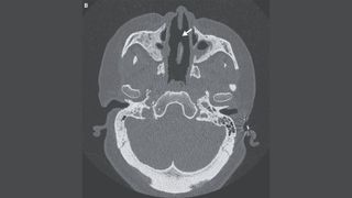 A CT scan of a woman's head shows an arrow pointing to a large hole in her septum
