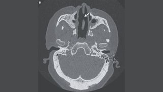 A CT scan of a woman&#039;s head shows an arrow pointing to a large hole in her septum