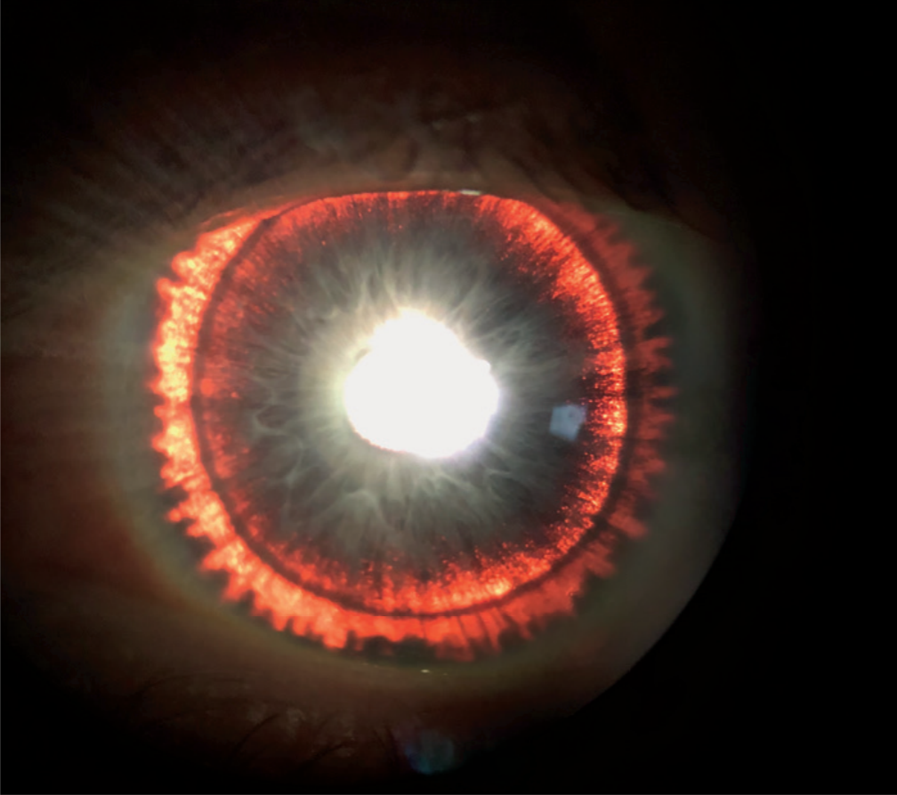 A man&#039;s eye exam revealed an eerie &quot;glow&quot; in his iris, which was a sign of a rare disorder that caused his eye pigment to flake off.