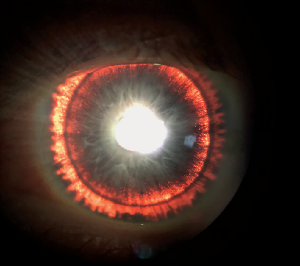 Man's 'Glowing' Iris Was a Sign of Rare Eye Syndrome