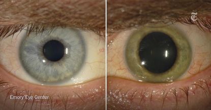 A man's eye with Ebola inside.