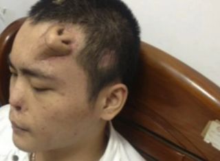 a man growing a replacement transplant nose on his forehead