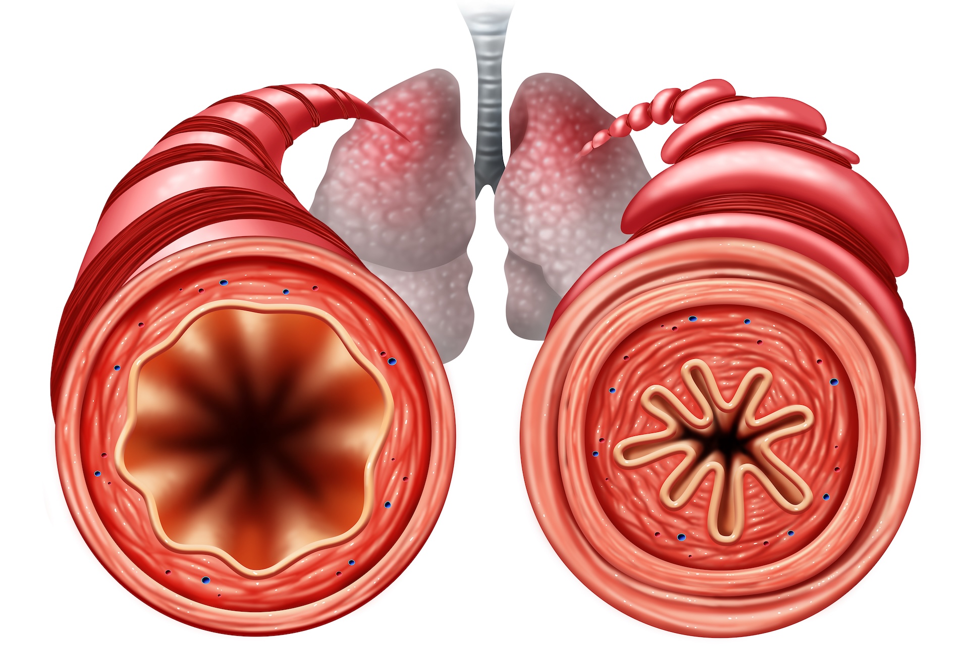 A diagram of two bronchial tubes. The one on the left has an open airway, whereas the one on the right is constricted and inflamed.