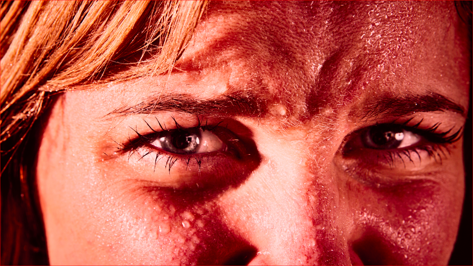 Diagnostic dilemma: A woman started sweating blood from her face and hands