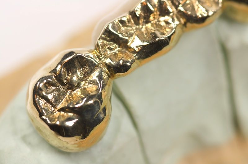 Vintage Bling: Ancient Celts May Have Had Shiny Dental Implants