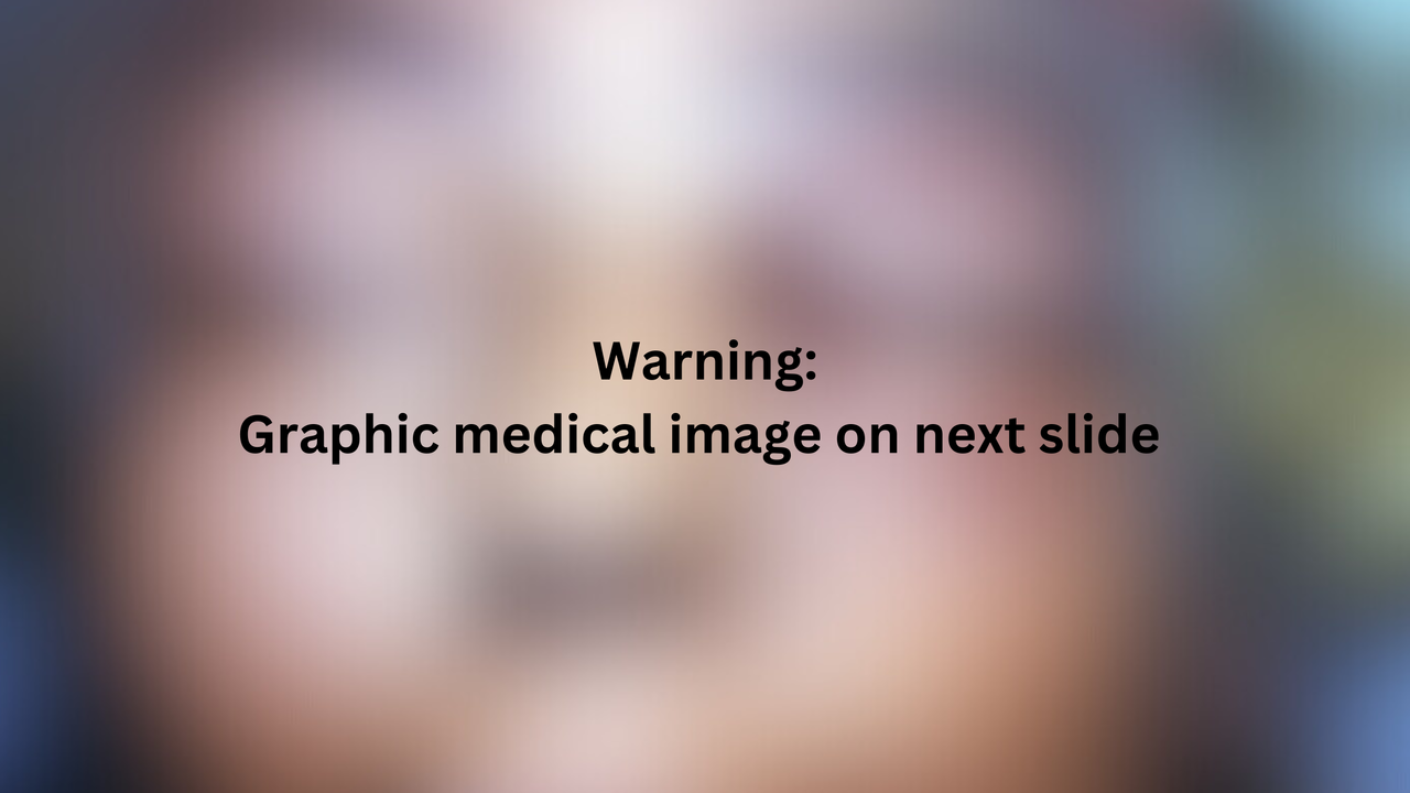 Black text is shown across a blurred image. The text reads "Warning: graphic medical image on next slide."