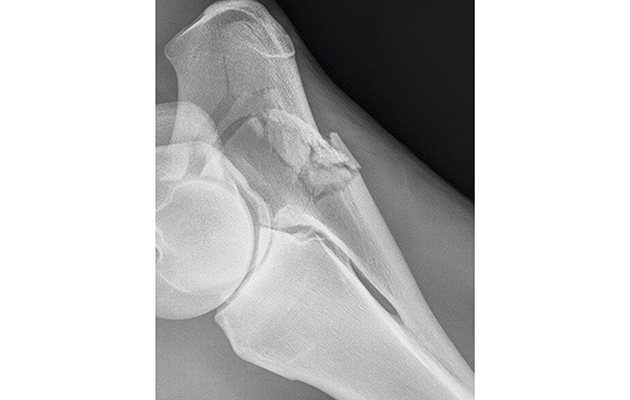 A radiograph of the fractured ulna before surgery